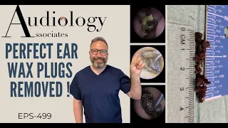 PERFECT EAR WAX PLUGS REMOVED - EP499