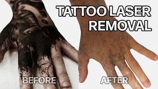 WHY DID I LASER OFF ALL MY TATTOOS? / TATTOO LASER REMOVAL