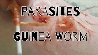 Guinea Worm || Parasites