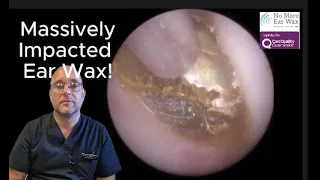 Massively Impacted Ear Wax! - Episode 76 #earwax #ear #earwaxremoval