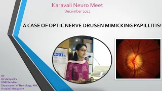 Optic Nerve Drusen mimicking papillitis. By Dr Shreya at the Karavali Neuro Meet Dec 2022