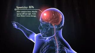 Types of cerebral palsy