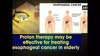 Proton therapy may be effective for treating esophageal cancer in elderly - U.S.A News