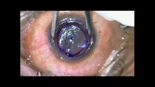 Half TILK for Karatoconus+PMD