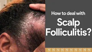 Dealing with Scalp Folliculitis? Watch immediately!