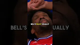 What is the main cause of Bell’s palsy and how is it different than having a stroke? 🤔🧠 #nba