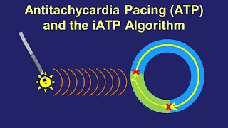 Antitachycardia Pacing (ATP) - How it Works, How to Improve