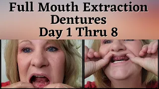 What To Expect With Immediate Dentures after Full Mouth Extraction