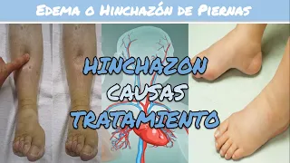 ⚕️🩺 HINCHAZÓN de PIERNAS, PIES y TOBILLOS o EDEMA de Miembros Inferiores: Causas y Tratamiento