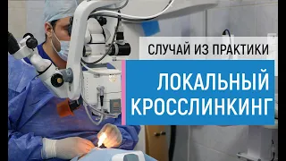 Операция локальный кросслинкинг по шагам. Случай из практики - лечение кератоконуса. Отзыв пациента.