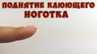 ❤Поднятие Клюющего ноготка❤Мой способ❤