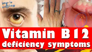 11 Signs and symptoms Vitamin B12 deficiency in adults