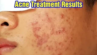 Cách điều trị mụn viêm, mụn bọc hiệu quả | Duy Phương | part 5. Tại Hiền Vân Spa - bài 258