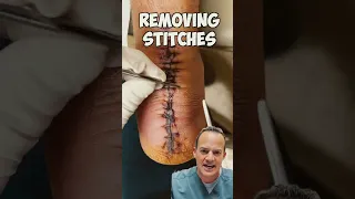 DOCTOR REACTS: REMOVING STITCHES! 😱 #shorts #satisfying