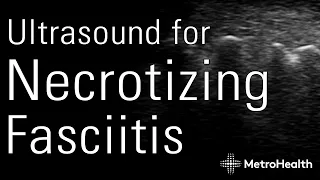 Ultrasound for Necrotizing Fasciitis