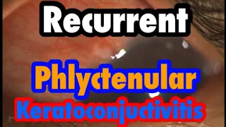 Treatment of recurrent Phlyctenular conjuctivitis معن البري