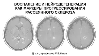 Воспаление и нейродегенерация как маркеры прогрессирования рассеянного склероза