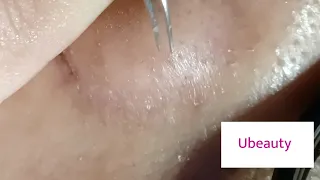 No squeezing whiteheads removal (Facial 26)