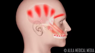 La ATM y el Síndrome de Dolor Miofascial,  Animación. Alila Medical Media Español.