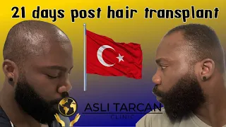 Asli Tarcan  black hair 21 days post DHI hair transplant results. Episode: 6