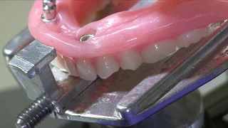 Eliminating Attachment Binding in Implant Overdentures