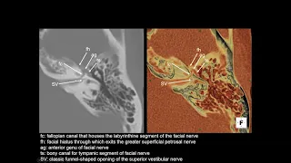 Imaging findings of Temporal bone