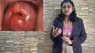 Nabothian cyst सर्विक्स बच्चेदानी के मुंह पर घाव का इलाज,क्या सफेद पानी