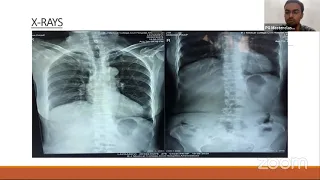 Surgical audit  on retroperitoneal lump