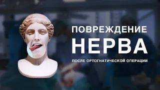 Повреждение нерва после ортогнатической операции