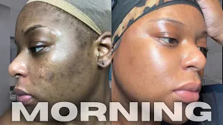 HOW I CLEARED MY HYPERPIGMENTATION AND DARK MARKS | MORNING SKINCARE ROUTINE