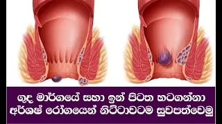 අර්ශෂ් රෝගයෙන් නිට්ටාවටම සුවපත්වෙමු | Hemorrhoids Piles Symptoms, causes, and treatments