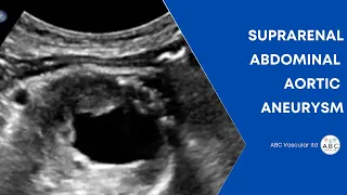Suprarenal Abdominal Aortic Aneurysm in previous infrarenal AAA repair | Ultrasound