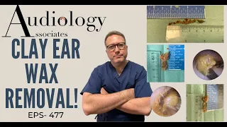 CLAY EAR WAX REMOVAL - EP477