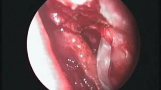 Endoscopic DCR