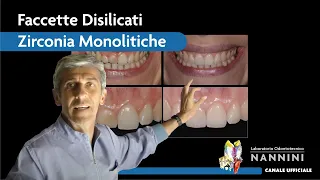 |* VIDEO CORSO *| Faccette Disilicati Zirconia Monolitiche