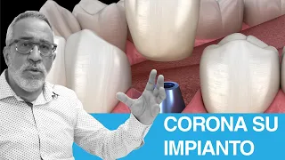 Impianto dentale: meglio corona avvitata o cementata?