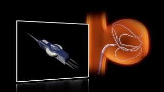 SwiftNinja® Steerable Microcatheter