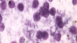 Pneumocystis Pneumonia & Pneumocystis Jirovecii