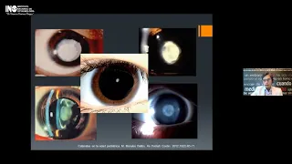 SALUD OCULAR EN LINEA: CATARATA CONGENITA