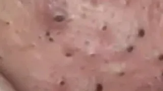 Huge Acne Pimples Blackheads Popping Up Satisfying with Oddly Calm Music Part One