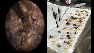 Massive Ear Wax Removal