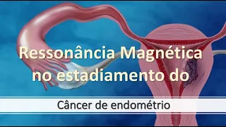 Ressonância Magnética - Estadiamento do câncer de endométrio.