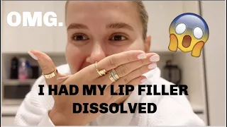 I HAD MY LIP FILLER COMPLETELY DISSOLVED | VLOG | MOLLYMAE