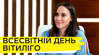 Вітиліго – що це за захворювання і як його визначити? – Тетяна Бойчук