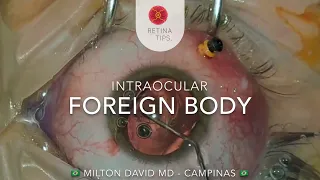 Intraocular Foreign Body – Internal Approach