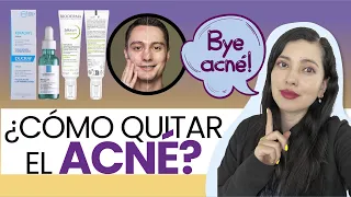 COMO QUITAR EL ACNÉ, Tips de una DERMATÓLOGA