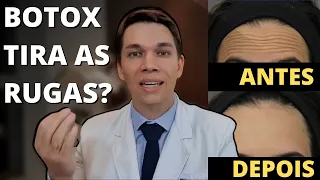 SEGREDOS DO BOTOX 👉 ANTES E DEPOIS | Será que Dói? | Tudo sobre Toxina Botulínica