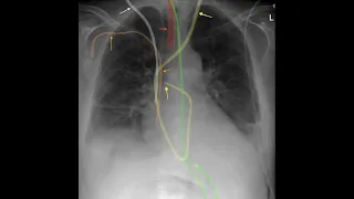Chest X-ray Lines and Tubes in 5 minutes