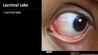 Lacrimal System - M1 Orbit & Eye Dissection Supplement