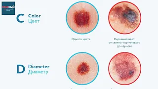 Меланома, базалиома и карцинома. Как выглядит рак кожи (фото). Симптомы и лечение рака кожи
